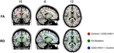 White Matter Changes in HIV+ Women with a History of Cocaine Dependence